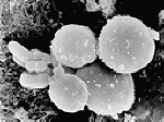 Le Bicarbonate du soude et le cancer , au cas ou ... Candida-2